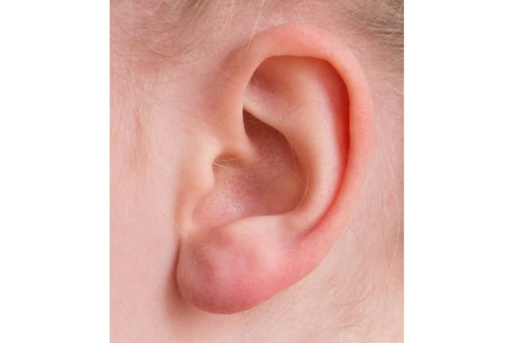 Atinnuris também ajuda com as dores de ouvidos